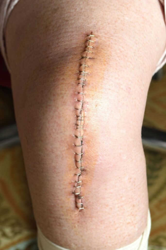 knee replacement incision line