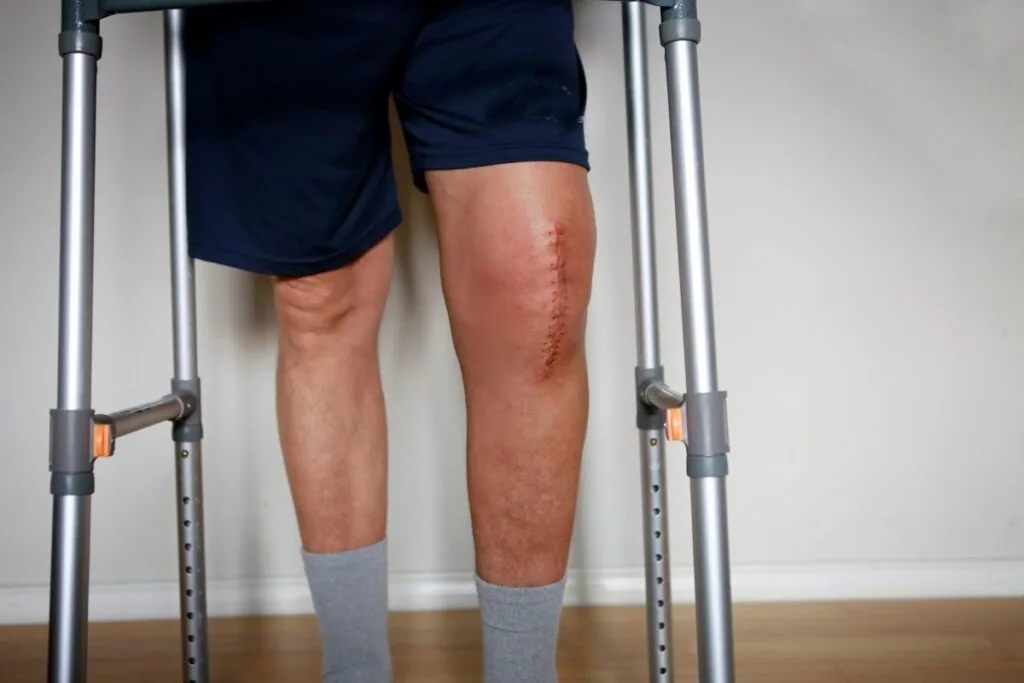 What to Wear After Knee Replacement Surgery: Comfort Meets Recovery 2 Knee replacement wound